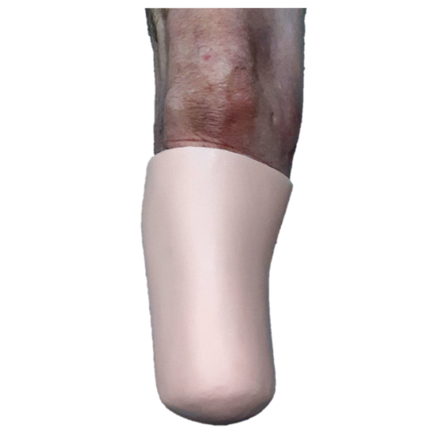 Copa Distal en Silicona de Alta Precisión para Amputaciones