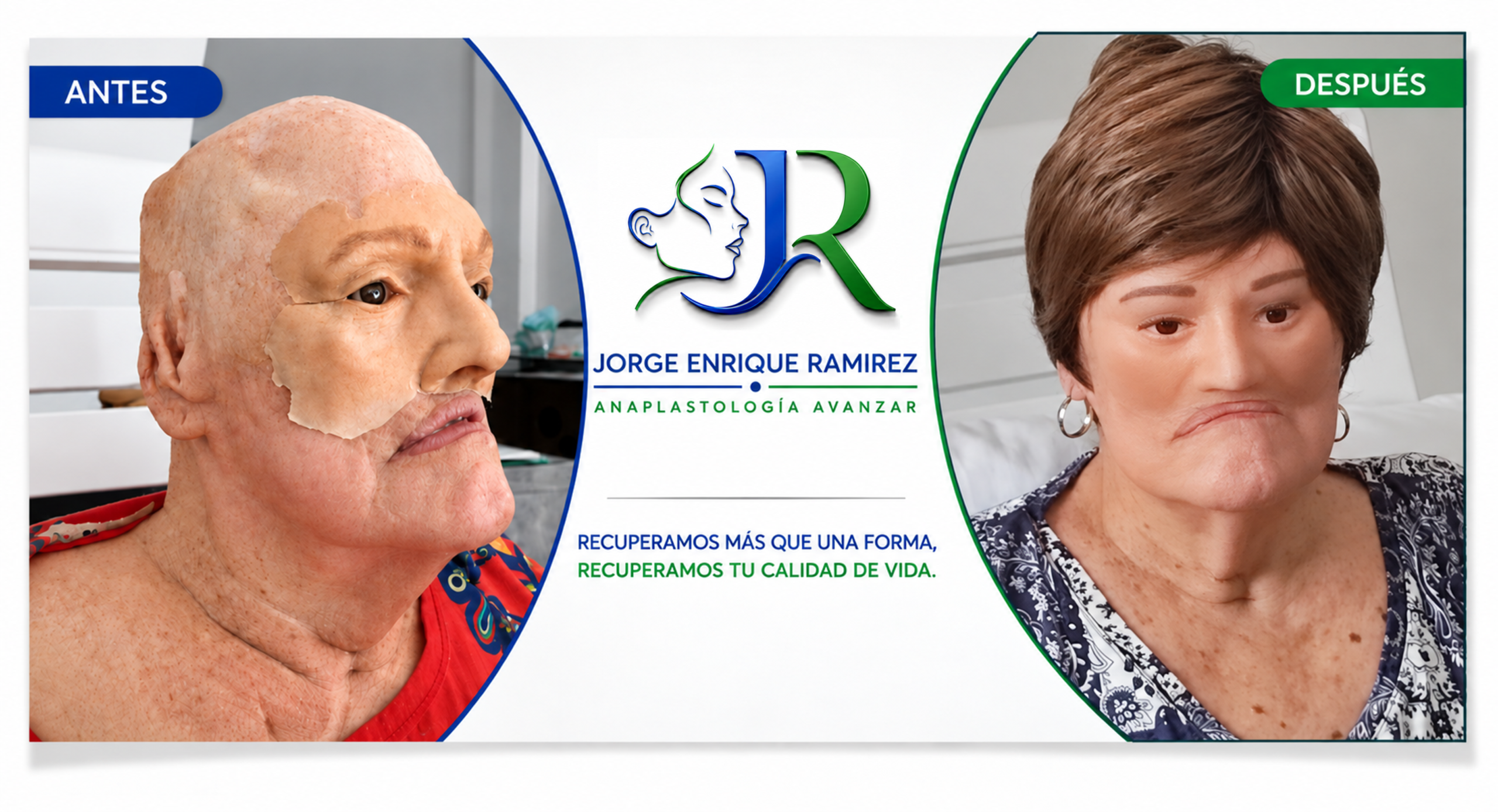 Conoce el proceso detrás de una prótesis personalizada en anaplastología