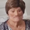 rostroJerAnaplastologia Prótesis Faciales Personalizadas: Recupera tu Imagen y Confianza